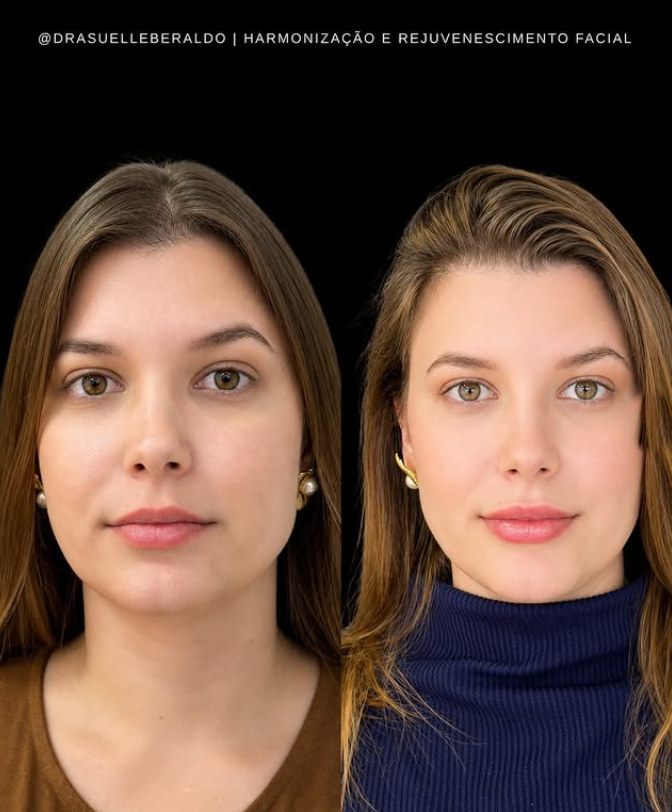 Antes e depois — harmonização facial e rejuvenescimento