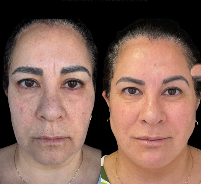 Antes e depois — frescor e leveza no olhar