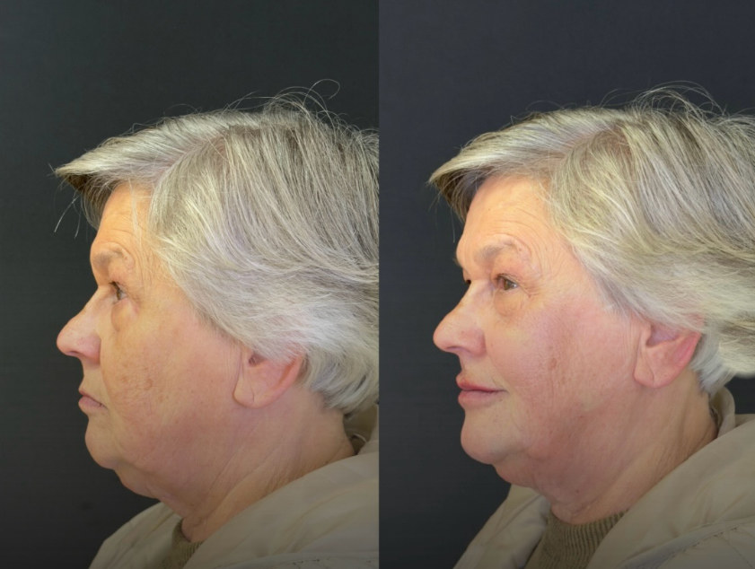 Antes e depois — resultado natural e elegante